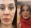 Claudia Raia mostrou o antes e depois de seu rosto após os procedimentos estéticos